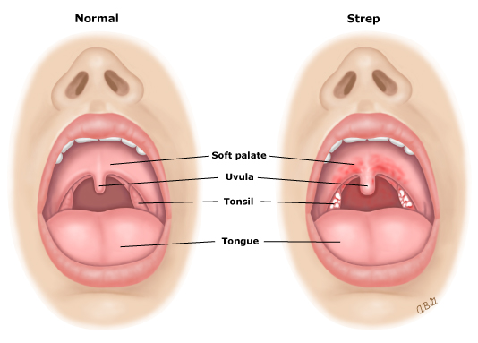 What is Sore Throat?